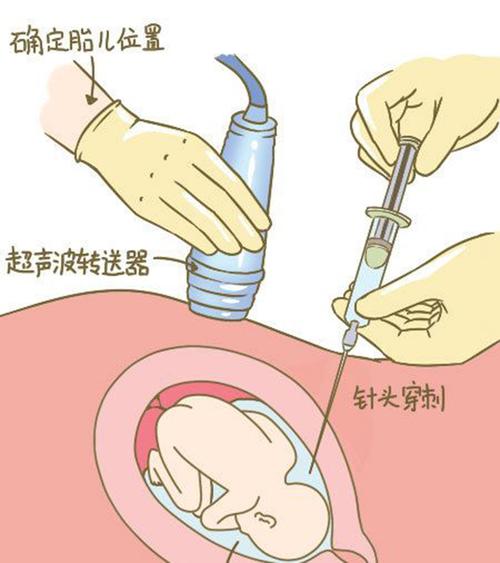 建德市羊水孕期亲子鉴定